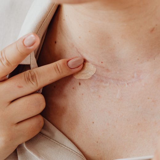 Comment cacher les cicatrices efficacement sur le visage et le bras ?