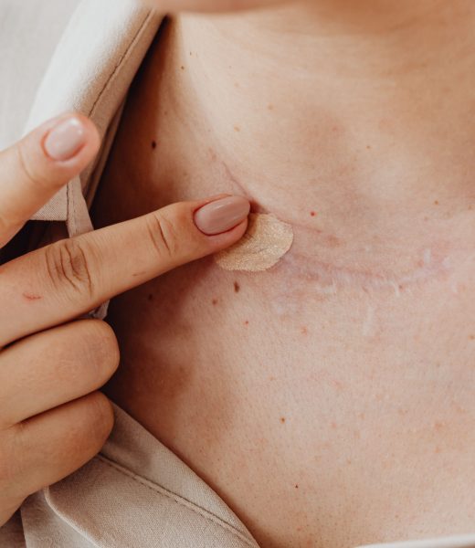 Comment cacher les cicatrices efficacement sur le visage et le bras ?