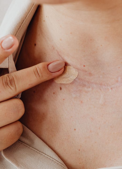 Comment cacher les cicatrices efficacement sur le visage et le bras ?
