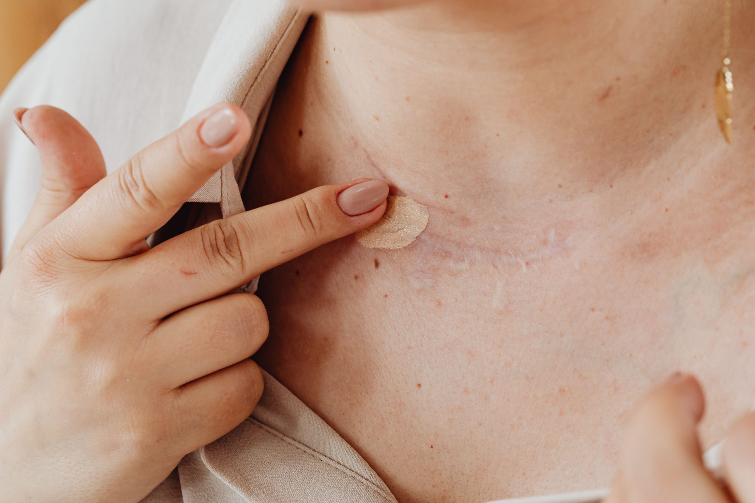 Comment cacher les cicatrices efficacement sur le visage et le bras ?