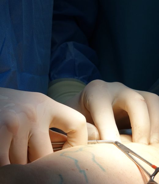 C&rsquo;est quoi une vasectomie, concrètement et sans tabou ?